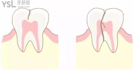 关于:牙隐裂的牙齿不治疗可以用多少年?该怎么保养?必戳这里