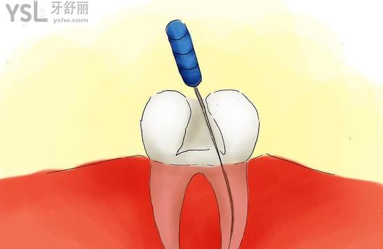 不过你这个不是说拔牙就完事了,拔了之后就要再把缺的牙补上,不然周边