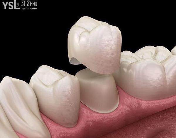 带牙冠过程多少时间,疼不疼,详细了解带牙冠过程步骤图解