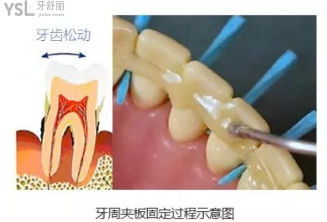 后槽牙轻微松动怎么办,会慢慢变好吗?