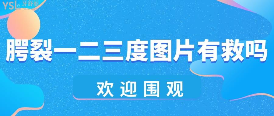 腭裂一二三度图片有救吗?国内腭裂修复医院推荐