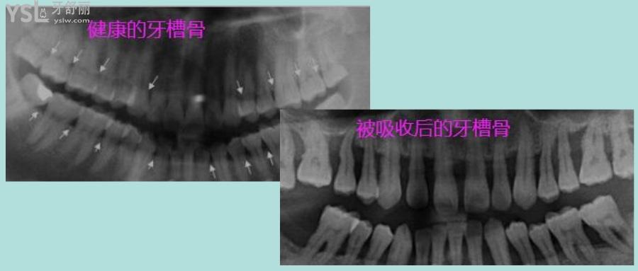 网友1385880提问牙槽骨吸收了还可以种植牙吗