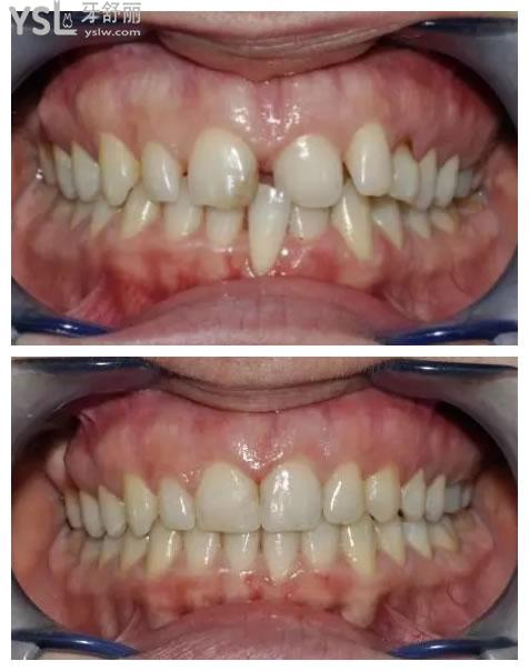 4,牙齿缺失不管,邻牙倒塌也会导致牙缝比较大 当门牙出现这些问题的