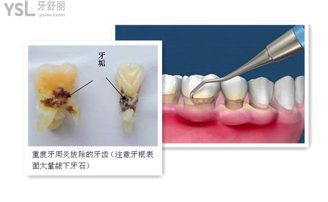 网友138***8835提问:龈下刮治后多久可以刷牙