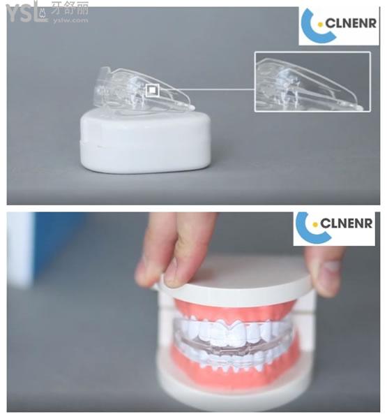 德国clnenr牙齿矫正器怎么样,德国clnenr牙齿矫正器多少钱贵不贵