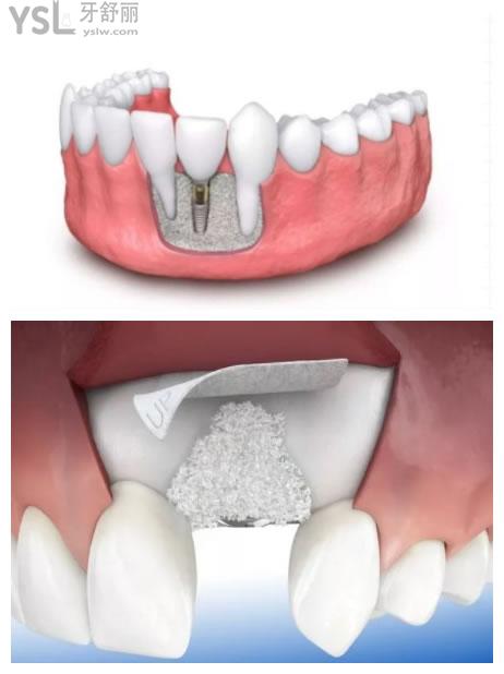 牙槽骨太薄适合做哪种种植技术