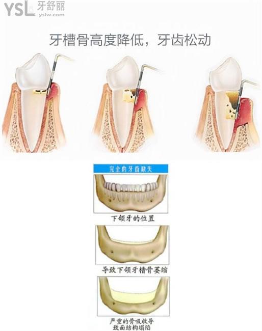 揭秘垂直型牙槽骨吸收还能恢复吗,一定要视情况而定哦