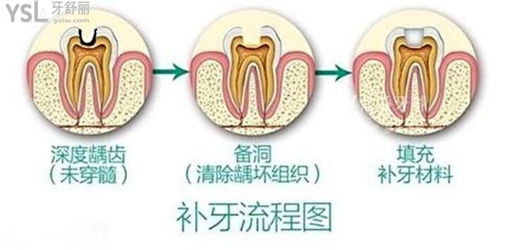 清潔受損部牙齒, 然後在空出的牙腔內注入填充物,以便恢復咀嚼的功能