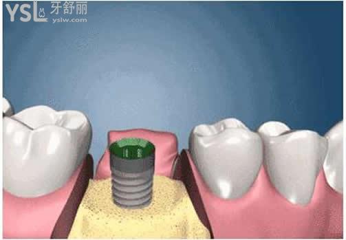 即刻种植牙是什么