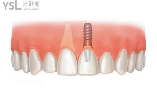 即可种植牙当天能使用吗
