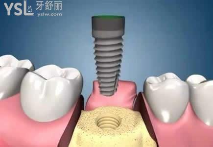 种植牙的使用寿命由哪些因素决定？