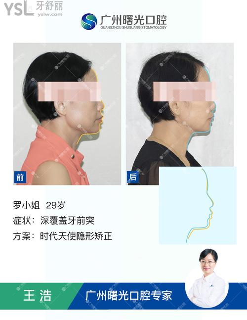 罗小姐-深覆盖牙前突.jpg