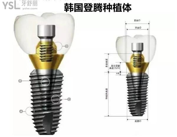 韩国登腾种植体