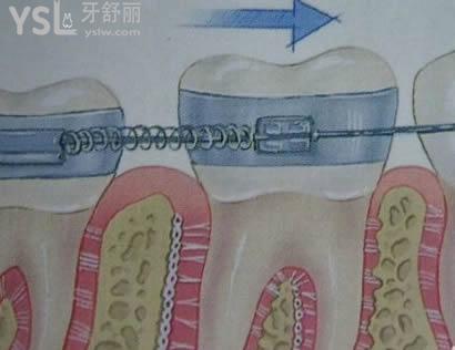 金属托槽会伤害牙齿吗？