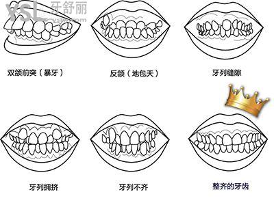 牙齿畸形图