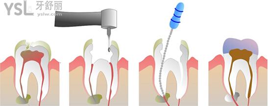深龋治疗方法