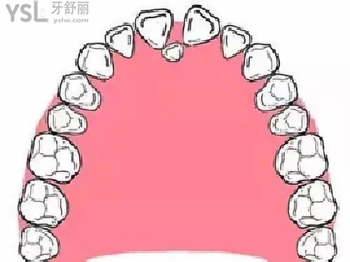 廣州越秀區拔埋伏牙3000一顆貴嗎,埋伏牙不拔有什麼危害