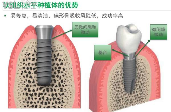 瑞士士卓曼是瑞士iti吗瑞士士卓曼种植体怎么又叫iti