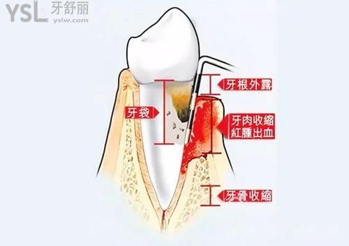 网友1389925提问牙周袋能自行治疗吗牙周袋图片有吗