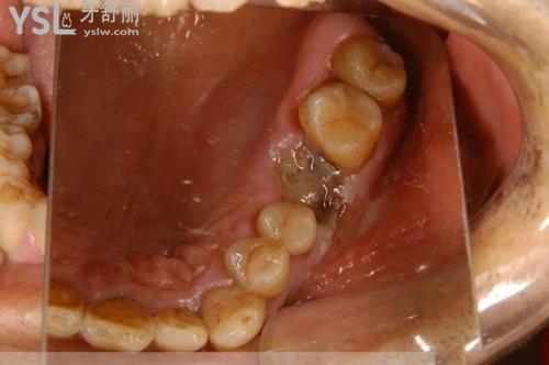牙龈癌一般都有前兆吗内含牙龈癌图片