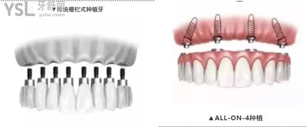 All-on-4种植技术