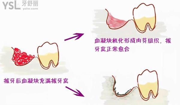 干槽症是什么图片