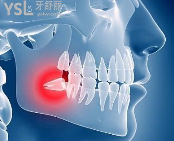 67智齿冠周炎是几级疼痛以及智齿冠周炎一定要拔牙吗