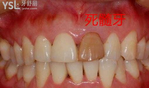 嵌体适用于死髓牙还是活髓牙,解析活髓牙和死髓牙的区别