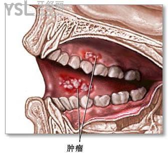 牙龈癌需几年形成附牙龈癌菜花样图片