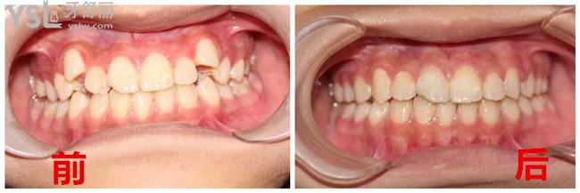 清远德艺口腔顾客虎牙矫正**