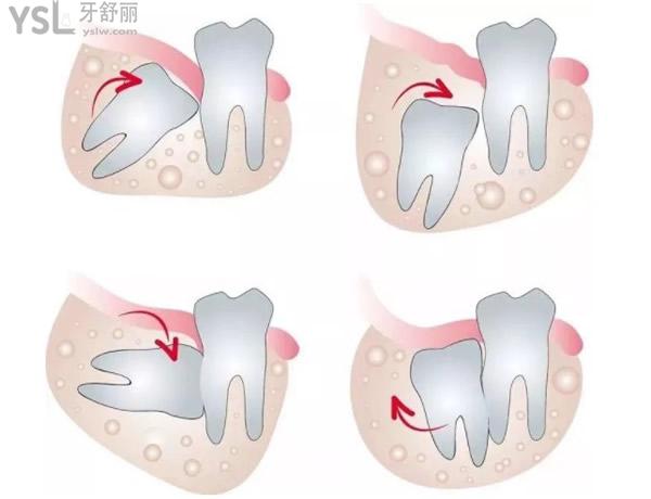 智齿的四种形态