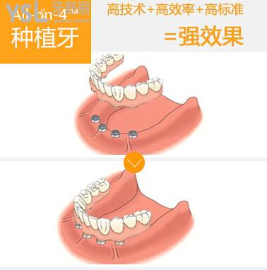 分享種牙小秘密allon4種植牙詳細步驟