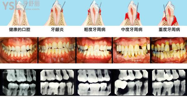 牙周炎 (2).jpg