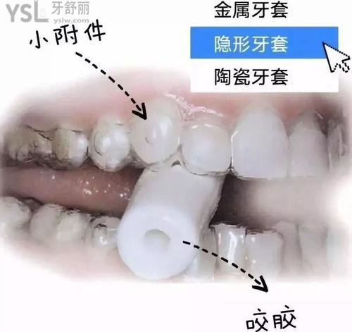 摘假牙套过程图解图片