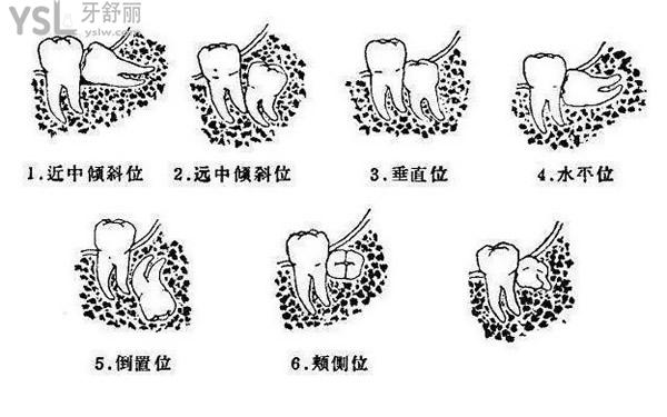 六种智齿形态