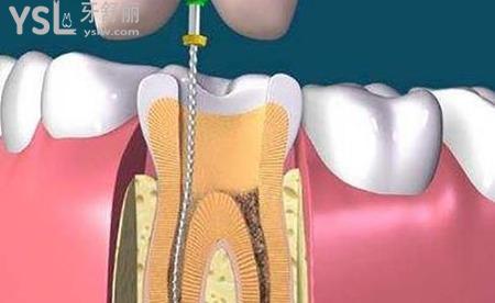 牙齿根管治疗后需要做牙套