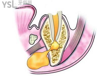 牙根尖炎如何快速消炎?這幾個方法你一定要知道