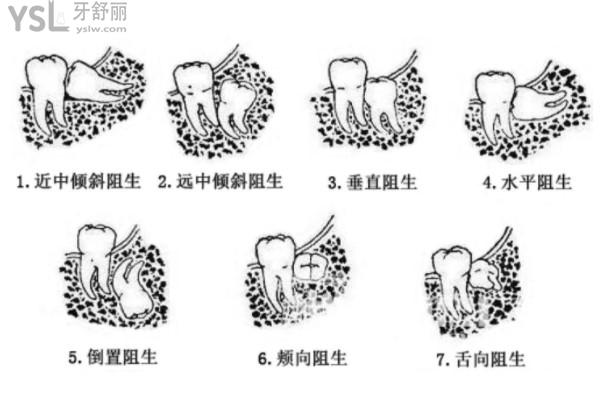 阻生智齿拔除难易排列顺序