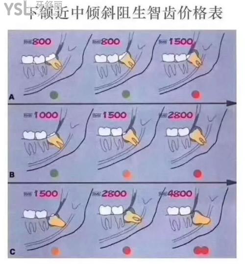 拔智齿难易程度排序图片