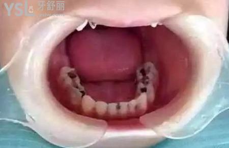 蛀牙引起的牙痛怎样缓解