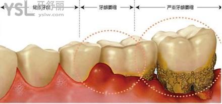 牙齦萎縮怎麼恢復正常牙周炎能徹底根治嗎