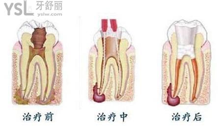 根管治疗第二次做什么