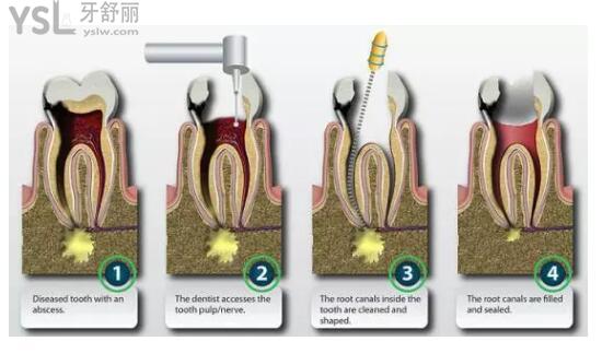 根管治疗图示