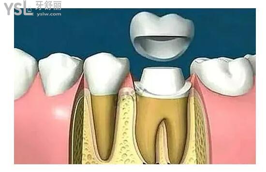 牙冠修复配图