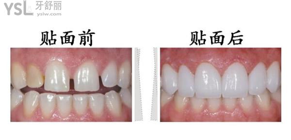 树脂补门牙缝前后图片图片