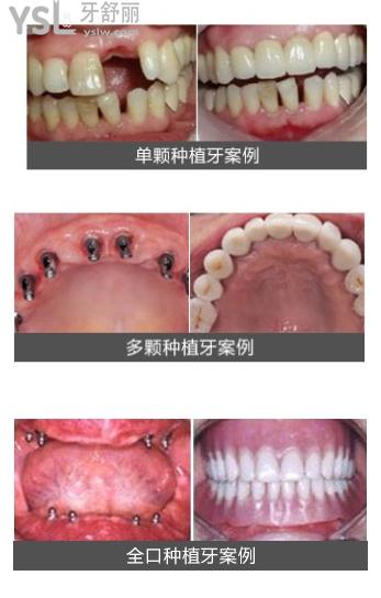 扬州贝恩口腔种植牙**图