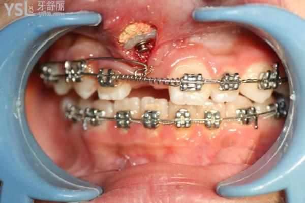 浅谈埋伏牙牵引成功率大吗及埋伏牙牵引正畸的费用多少?