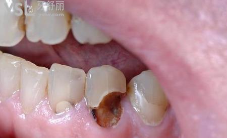 网友1386054提问牙齿根部发炎怎么治疗