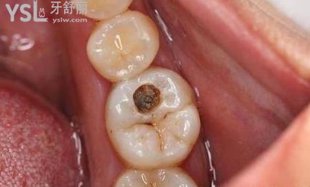 网友1386081提问牙齿上烂了个洞不去补牙会怎样