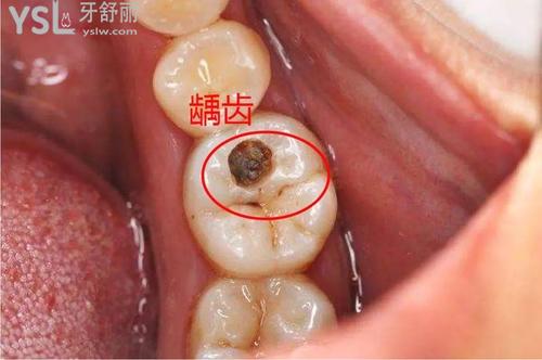 补牙的流程及步骤是什么？过程超简单